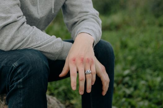close-up of swollen red knuckles on a human hand