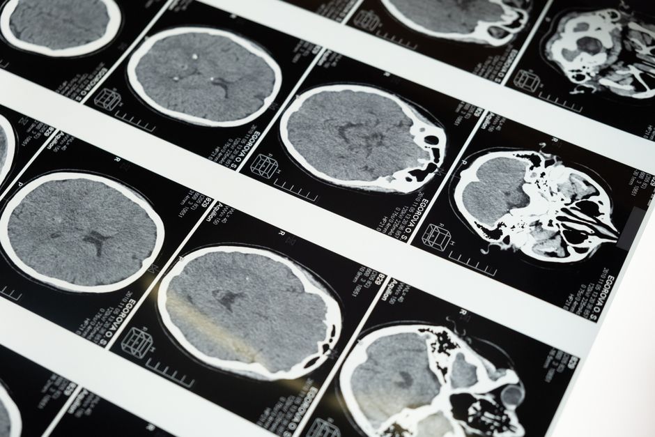 Early Signs of Neurological Disorders You Shouldnt Ignore illustration 9